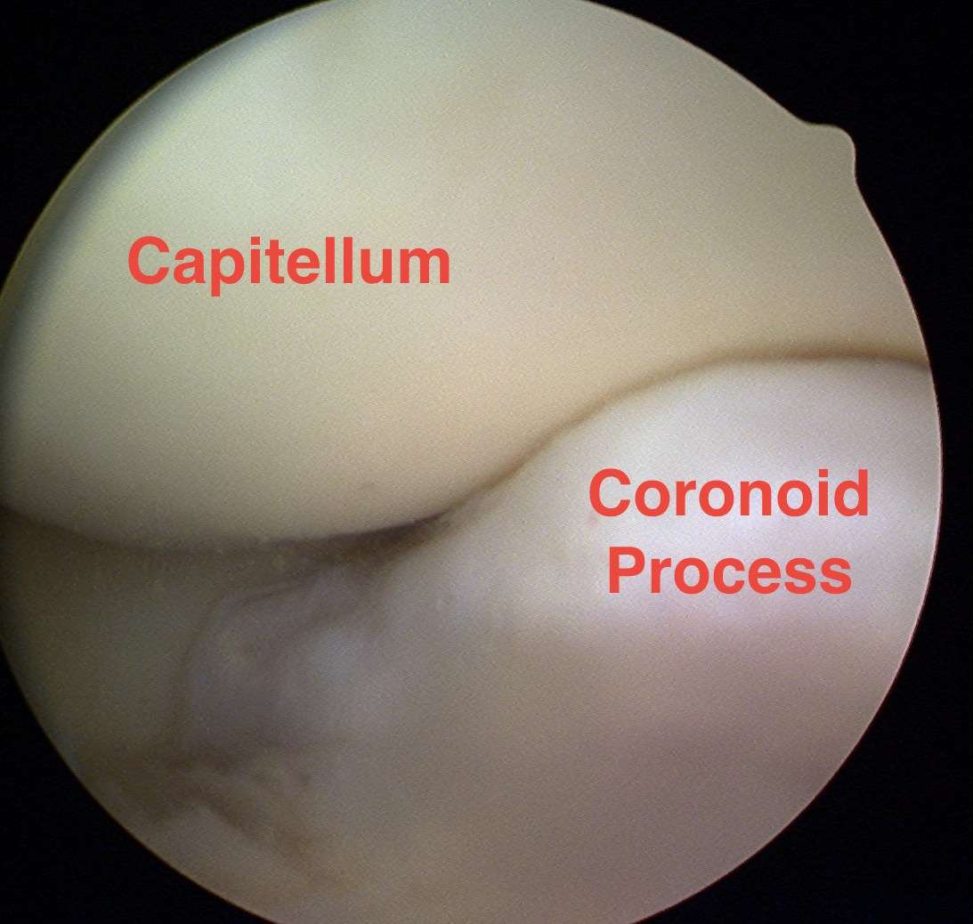 Elbow Arthroscopy Anterior Compartment